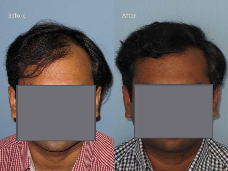 Dr. Paul Shapiro, MD 
FUT 2974 grafts 
12 months post-op