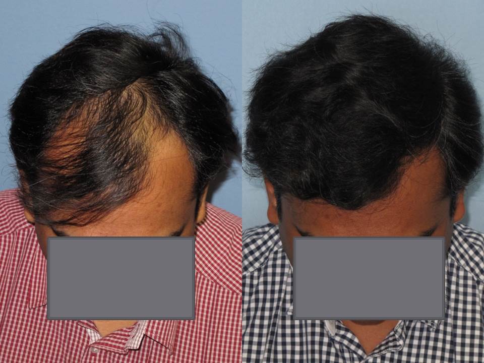 Dr. Paul Shapiro, MD 
FUT 2974 grafts 
12 months post-op