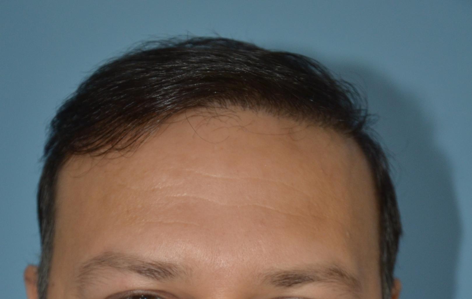 Click image for larger version

Name:	Best-FUE-hair-transplant-India (5).jpg

Size:	90.2 KB
ID:	53278