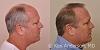 Linear Strip Hair Transplant Results at 6 months - Anderson Center for Hair