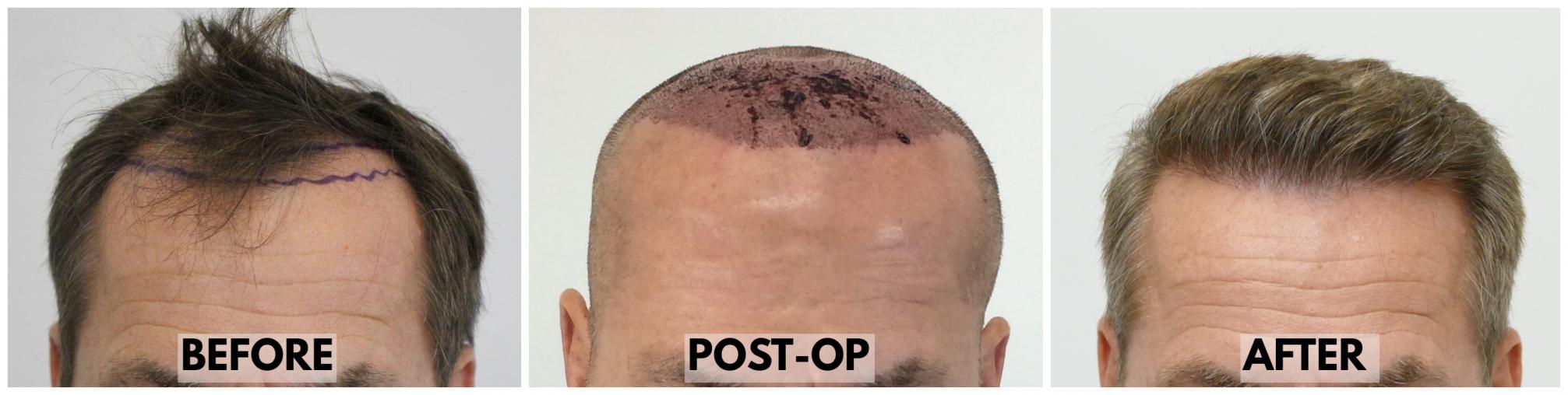 Click image for larger version

Name:	Before-Postop-After-Hairline.jpg

Size:	106.8 KB
ID:	72678