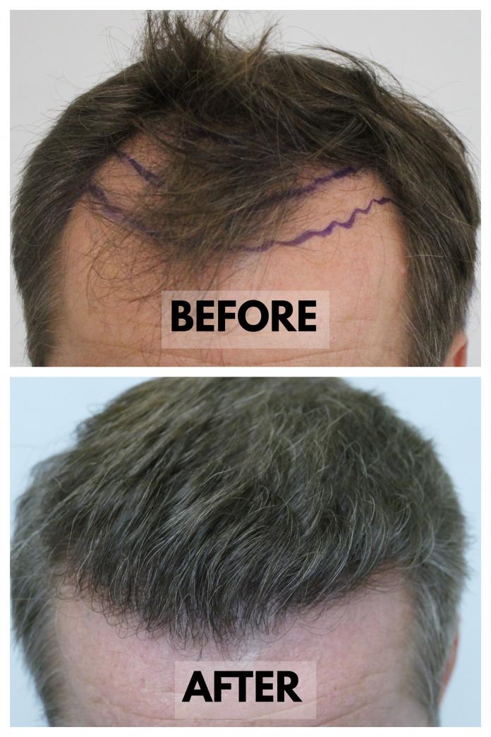 Click image for larger version

Name:	Before-After-HairlineCloseup.jpg

Size:	94.5 KB
ID:	72684
