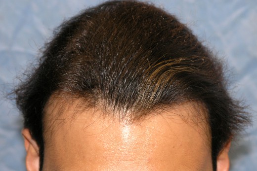 Click image for larger version

Name:	04_after-hair-repair-top-view.jpg

Size:	52.9 KB
ID:	12692