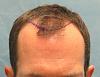 Click image for larger version

Name:	1b_position-of-planned-hairline_gkl.jpg

Size:	89.2 KB
ID:	46261