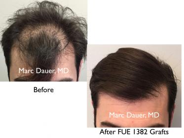 Click image for larger version

Name:	Hair Transplant Slides copy26.001.jpg

Size:	14.2 KB
ID:	44631