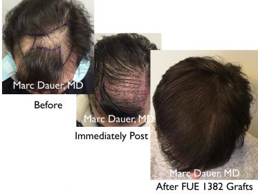 Click image for larger version

Name:	Hair Transplant Slides copy26.004.jpg

Size:	16.5 KB
ID:	44634