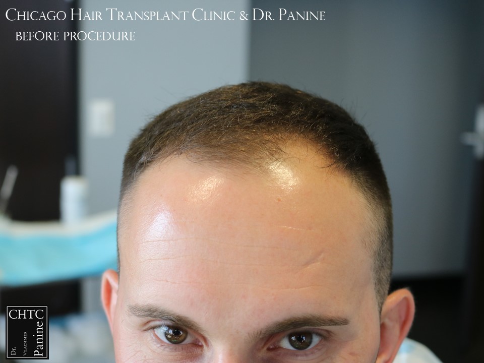 PANINE, MD FUE Hair Transplant Results