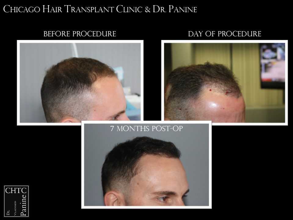 PANINE, MD FUE Hair Transplant Results