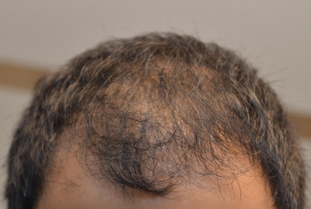 Click image for larger version

Name:	Hairline.jpg

Size:	75.6 KB
ID:	49829