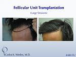 This 43-year-old man desired to reverse the progressive recession of his hairline. A total of 4480 grafts were transplanted to the frontal half of...