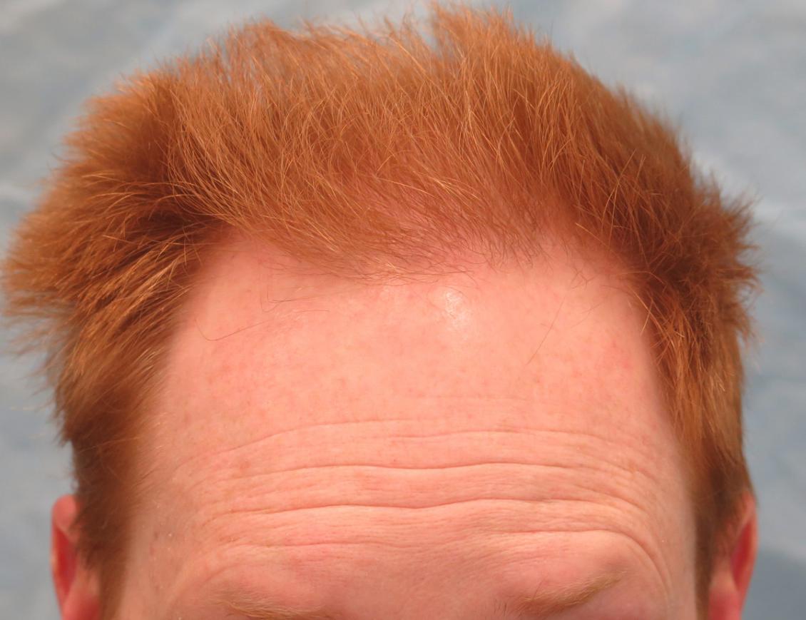 Click image for larger version

Name:	1d_after-hair-transplant_ryl.jpg

Size:	88.3 KB
ID:	47479