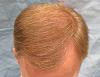 Click image for larger version

Name:	2d_after-hair-transplant-top-view_rfr.jpg

Size:	92.4 KB
ID:	47292
