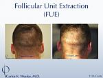 An example of short-term donor area recovery after follicular unit extraction (FUE) with Dr. Carlos K. Wesley (NYC). 
 
A video montage of many more...
