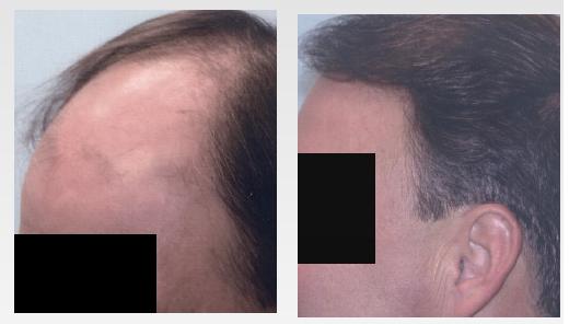 Before and after hair transplant procedure