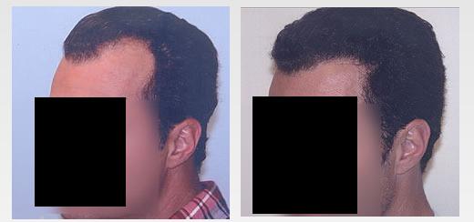 Before and after hair transplant procedure