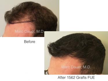 1562 grafts FUE performed by Dr. Marc Dauer