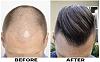 Click image for larger version

Name:	hair-transplant-Before-After.jpg

Size:	20.0 KB
ID:	67878