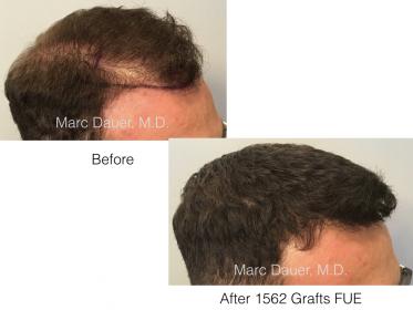 1562 grafts FUE performed by Dr. Marc Dauer