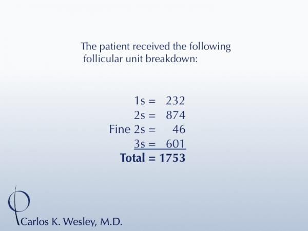 A 32-year-old female visited the office of Dr. Carlos K. Wesley with the desire to fill in her hairline. He performed a 1753 FU session and she...