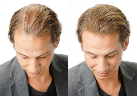 Propecia for hair loss treatment1