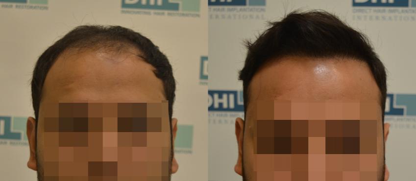 3,134 hair implanted,14 months result, Norwood Scale 02