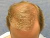 Click image for larger version

Name:	05_before-hairline-restoration-top-view.jpg

Size:	59.5 KB
ID:	7113