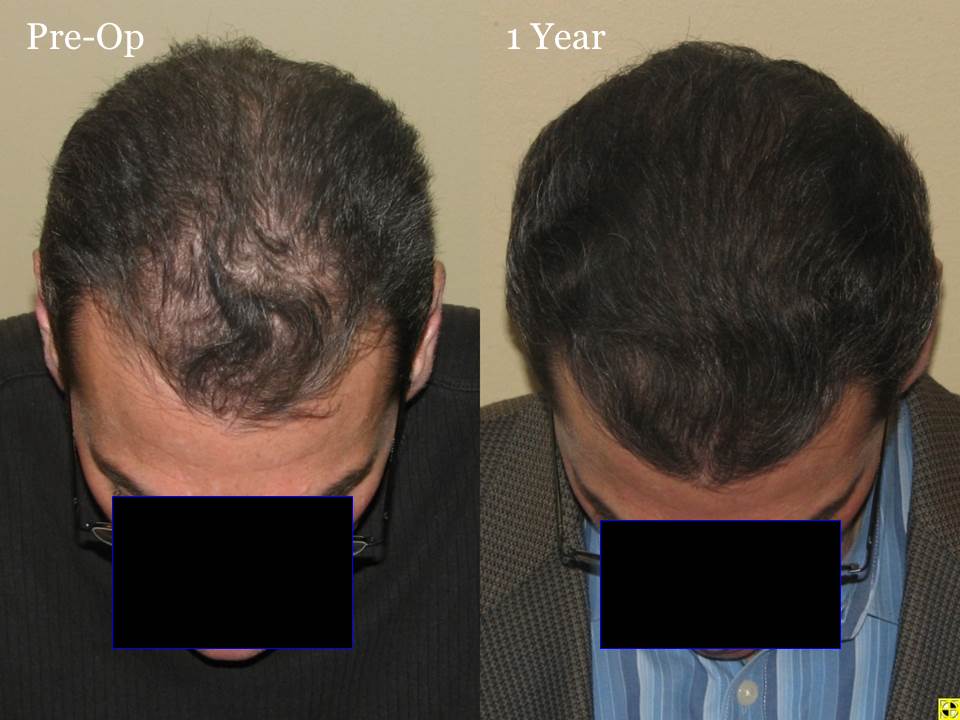 Paul Shapiro, MD 
FUT 2619 grafts 
12 months post-op