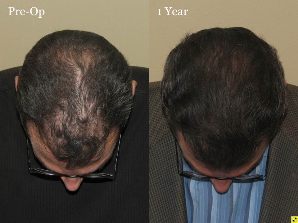 Paul Shapiro, MD 
FUT 2619 grafts 
12 months post-op