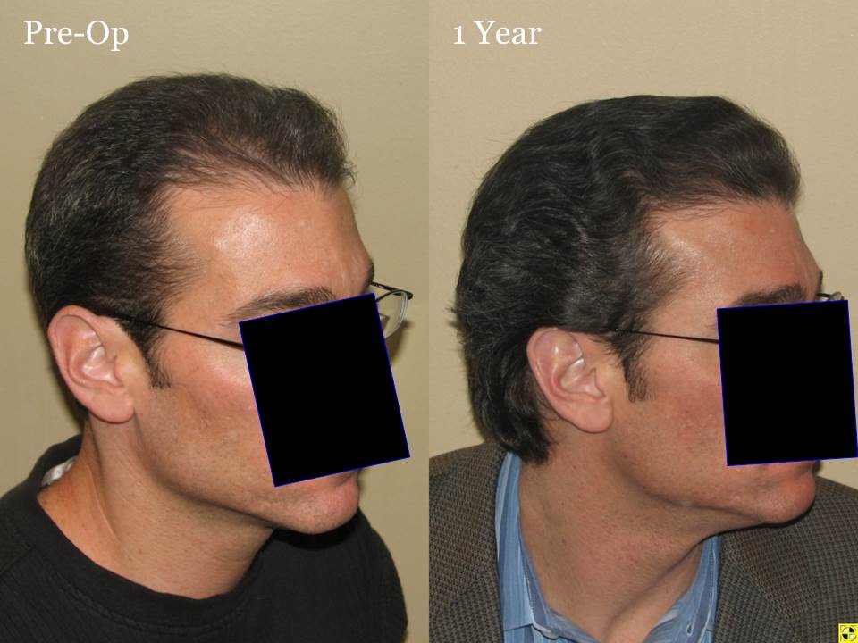 Paul Shapiro, MD 
FUT 2619 grafts 
12 months post-op