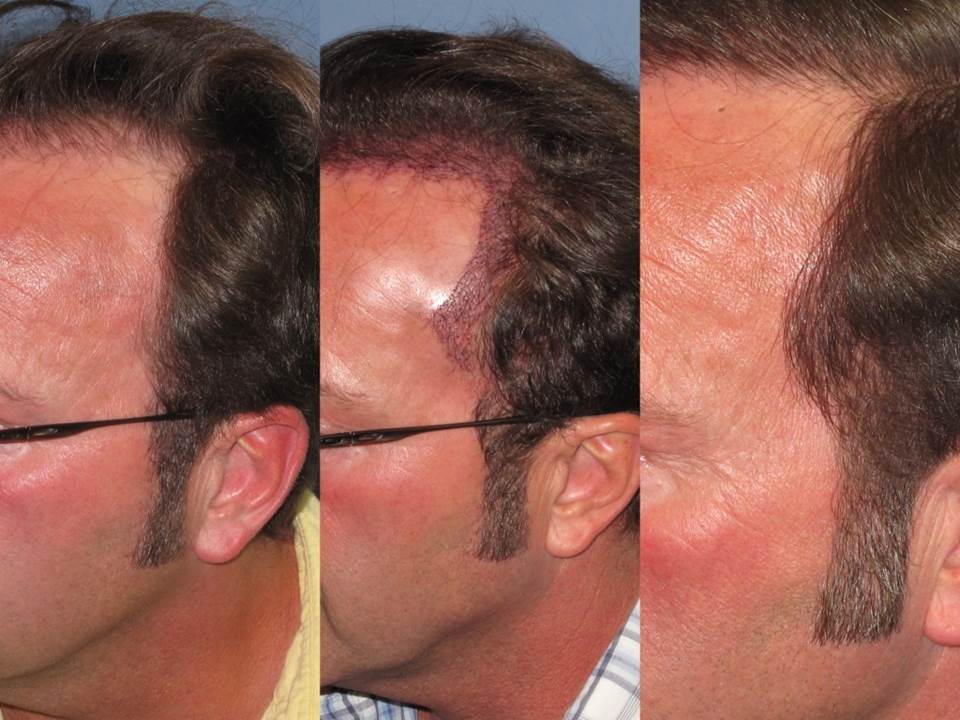 Dr. Paul Shapiro, MD 
FUT 2103 grafts 
 12 months post op