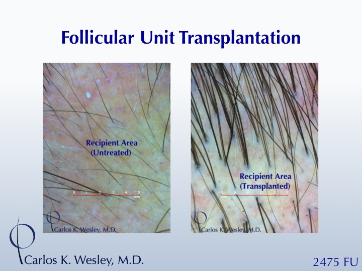 This 42-year-old man had two bad transplants at another office prior to coming to Dr. Wesley (NYC) for a revision of his hairline and subsequent mid...