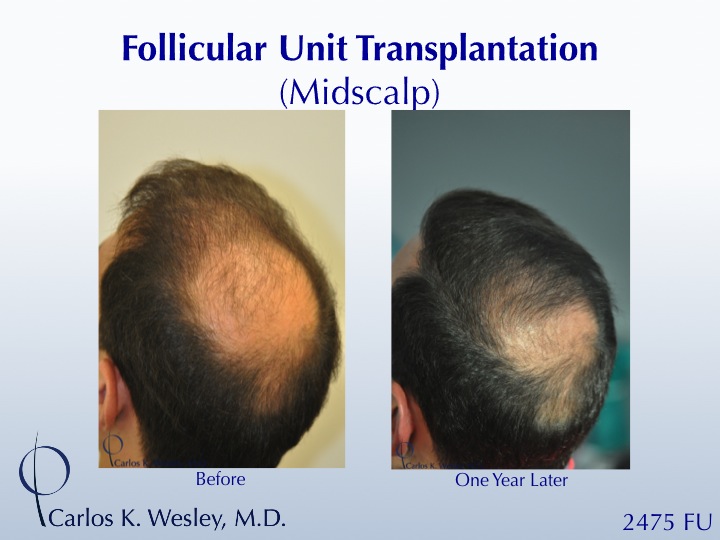 This 42-year-old man had two bad transplants at another office prior to coming to Dr. Wesley (NYC) for a revision of his hairline and subsequent mid...