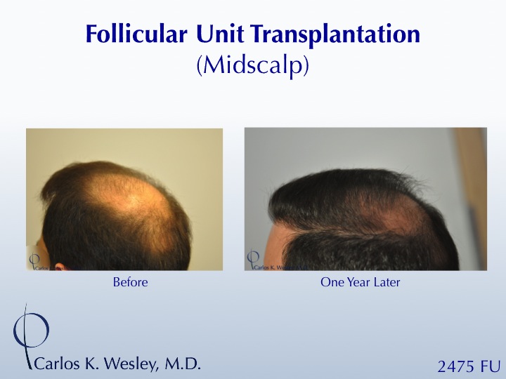 This 42-year-old man had two bad transplants at another office prior to coming to Dr. Wesley (NYC) for a revision of his hairline and subsequent mid...