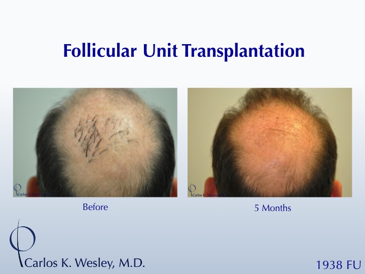 This patient presented to Dr. Carlos K. Wesley for a repair of work performed many years prior at a different clinic.  A video of his transformation...