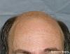 Click image for larger version

Name:	03_before-hair-transplant.jpg

Size:	23.6 KB
ID:	24975