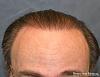Click image for larger version

Name:	04_after-3rd-hair-transplant.jpg

Size:	22.3 KB
ID:	24976
