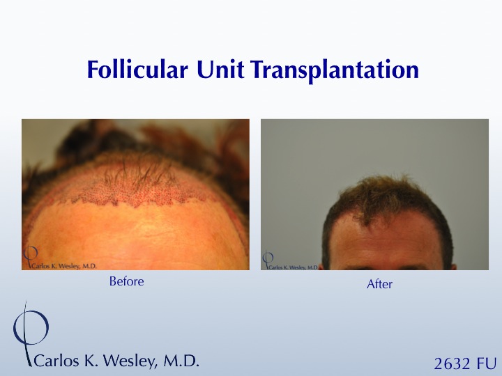 This patient presented to Dr. Carlos K. Wesley (NYC) for a hairline advancement.