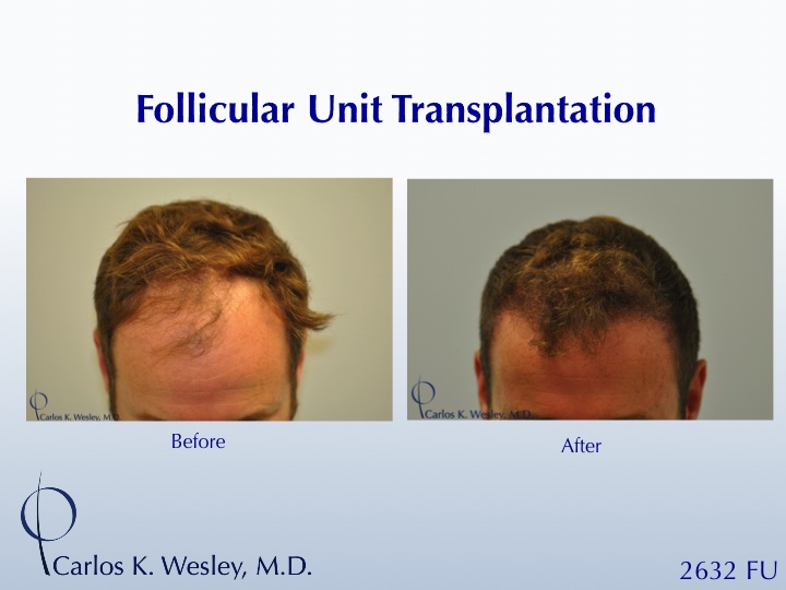 This patient presented to Dr. Carlos K. Wesley (NYC) for a hairline advancement.