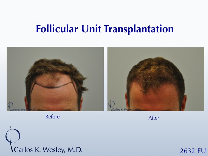 This patient presented to Dr. Carlos K. Wesley (NYC) for a hairline advancement.