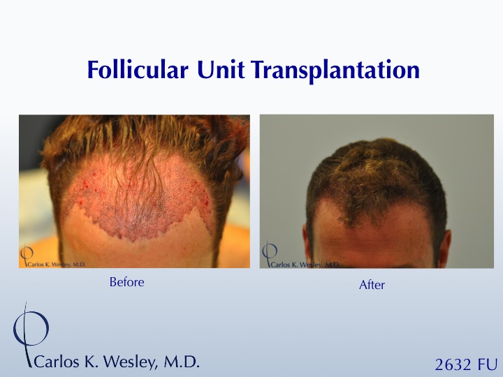 This patient presented to Dr. Carlos K. Wesley (NYC) for a hairline advancement.