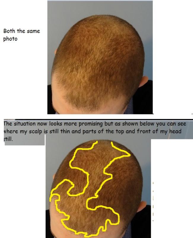 Click image for larger version

Name:	7 Current Hair Loss #2.jpg

Size:	50.2 KB
ID:	36895
