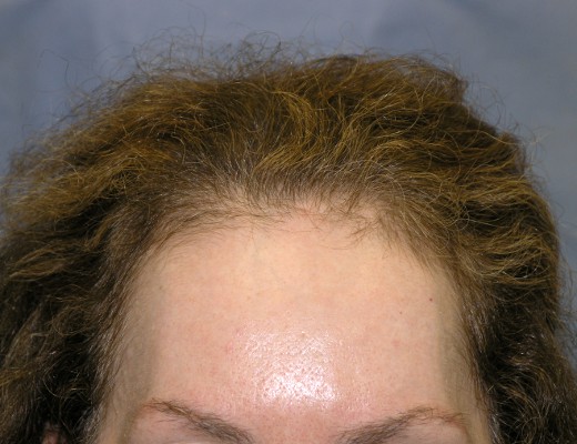 Click image for larger version

Name:	03_before-hair-restoration.jpg

Size:	61.0 KB
ID:	14238