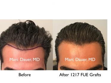 Click image for larger version

Name:	Hair Transplant Slides copy811.004.jpg

Size:	15.1 KB
ID:	49129