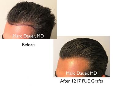 Click image for larger version

Name:	Hair Transplant Slides copy811.007.jpg

Size:	12.6 KB
ID:	49131