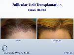 A 32-year-old female visited the office of Dr. Carlos K. Wesley with the desire to fill in her hairline. He performed a 1753 FU session and she...