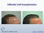 This 40-year old underwent surgical hair restoration with Dr. Carlos K. Wesley (NYC).  He received 2460 grafts (300 of which were DFUs) and presented...