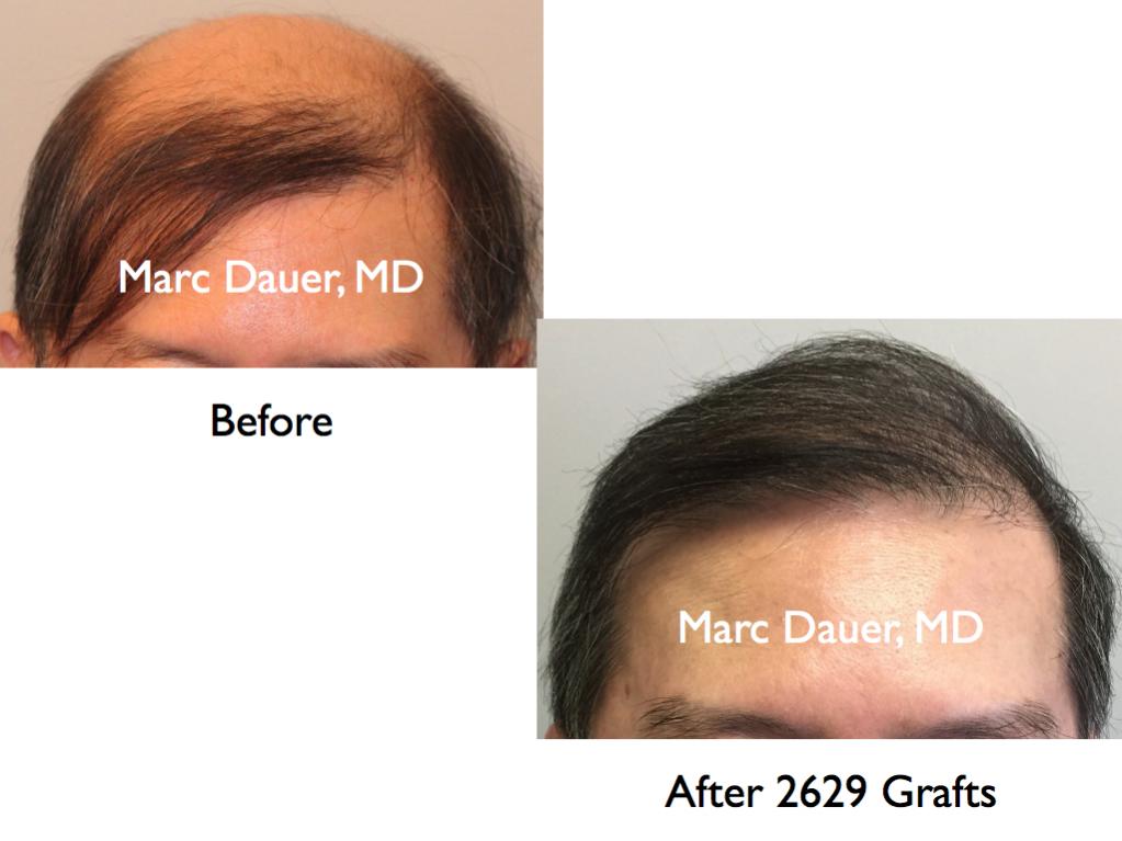 Click image for larger version

Name:	Hair Transplant Slides1.369.jpg

Size:	60.1 KB
ID:	36508