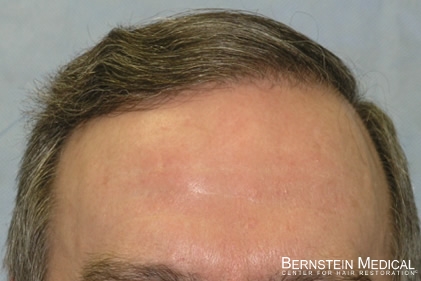 Click image for larger version

Name:	hairline-a3rd.jpg

Size:	68.4 KB
ID:	26310