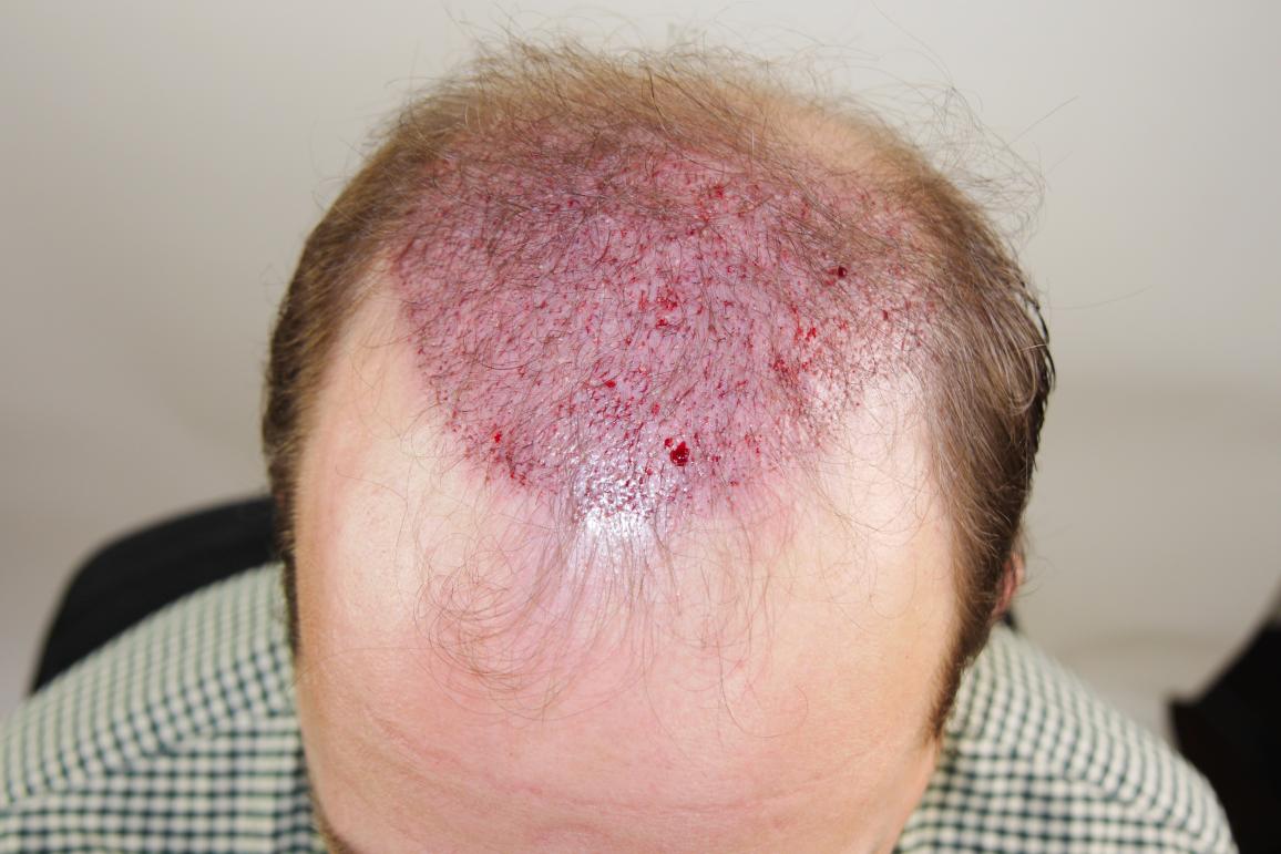 Click image for larger version

Name:	sd imm post-op chin down.jpg

Size:	93.1 KB
ID:	41284