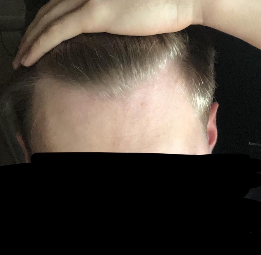 Click image for larger version

Name:	Front hairline 2.jpg

Size:	58.0 KB
ID:	67407